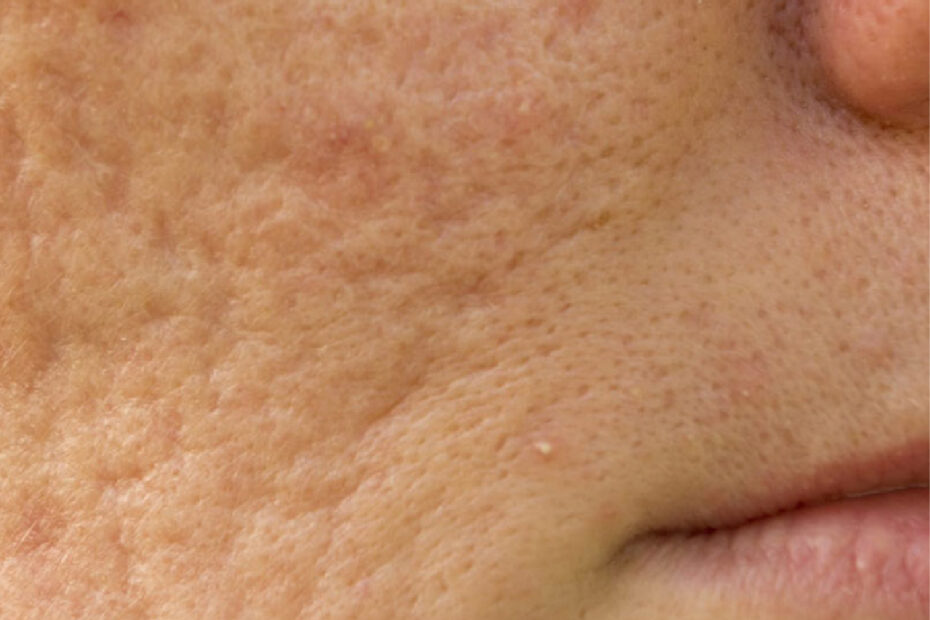 acne scars